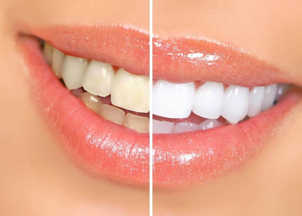 What are Teeth Whitening Kits?